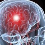 Что нужно делать, чтобы предотвратить инсульт?